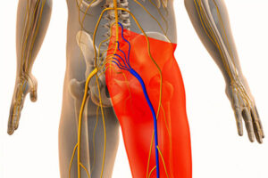 Sciatic nerve compression causing hip and thigh pain