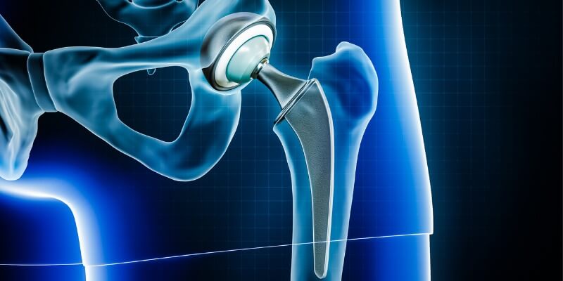 Left total hip replacement prosthetic